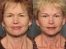 Brow Lift