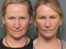 Brow Lift