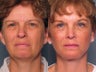 Brow Lift