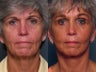 Brow Lift