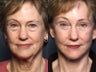 Brow Lift