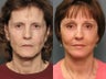 Brow lift