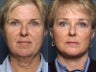 Brow Lift