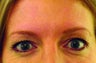 Brow lift with BOTOX