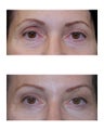 Lateral Brow Lift