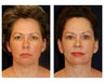 Facial Rejuvenation