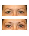 Brow lift