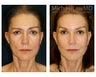 Brow lift & Fat Transfer