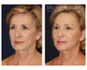 Facial Rejuvenation