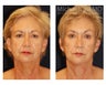 Facial Rejuvenation - Brow Lift