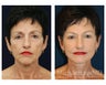 Facial Rejuvenation - Brow Lift