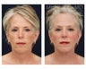 Facial Rejuvenation - Brow Lift