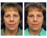 Facial Rejuvenation - Brow Lift