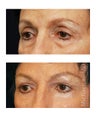 Facial Rejuvenation - Brow Lift
