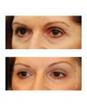 Facial Rejuvenation - Brow Lift