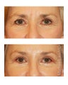 Facial Rejuvenation - Brow Lift