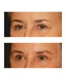Facial Rejuvenation - Brow Lift