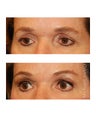 Facial Rejuvenation - Brow Lift