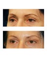 Facial Rejuvenation - Brow Lift