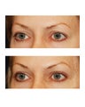 Brow lift