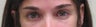 Lateral hood lift and blepharoplasty