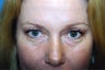 Browlift Procedure