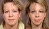 Brow Lift