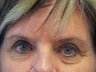 Brow Lift