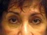 Brow Lift