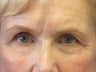 Brow Lift