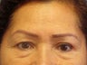 Brow Lift