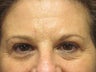 Brow Lift