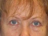 Brow Lift