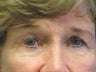 Brow Lift