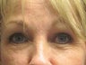 Brow Lift