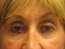 Brow Lift