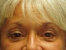 Brow Lift