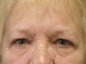 Brow Lift