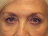 Brow Lift