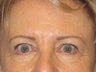 Brow Lift