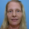Brow Lift with Upper and Lower Blepharoplasty
