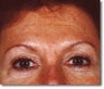 Brow Lift