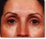 Brow Lift