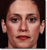Brow Lift