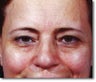 Brow Lift