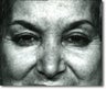 Brow Lift