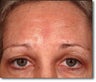 Brow Lift