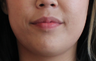 Buccal Fat Removal