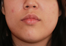 Buccal Fat Removal
