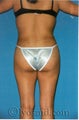Butock Augmentation